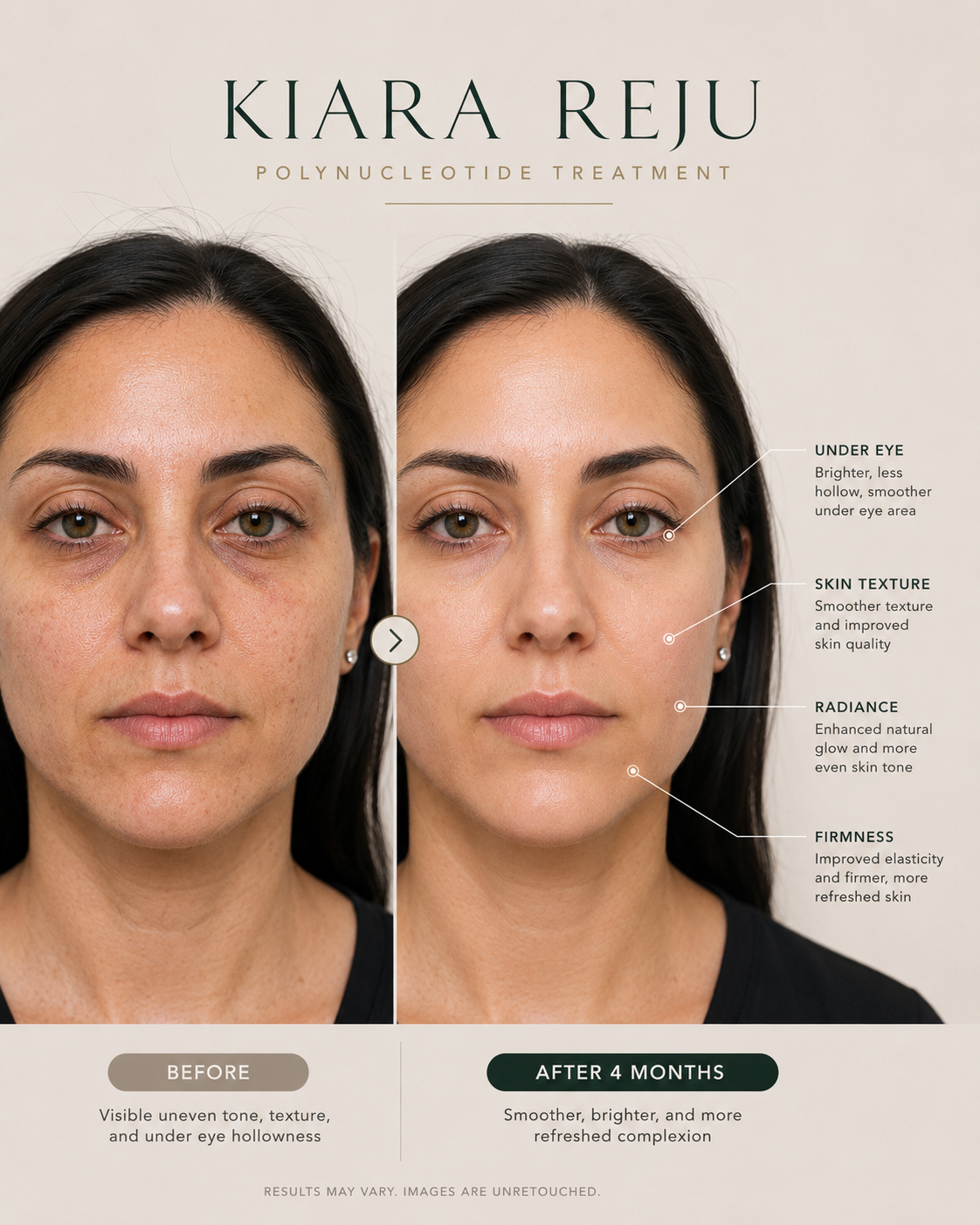 Kiara Reju skin treatment information at ClearSkin4u