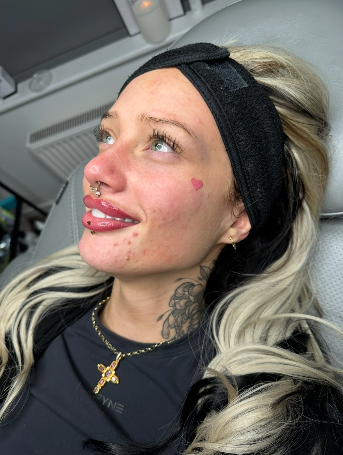 Client at the beginning of her hormonal acne skin journey